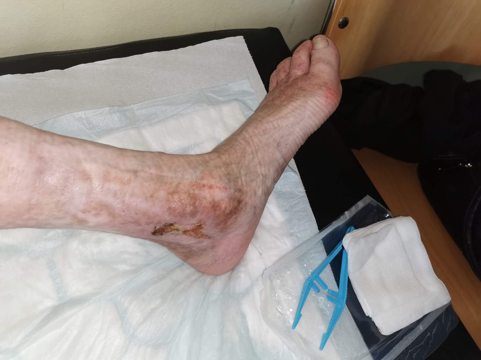  kompleksna kot je laserski poseg